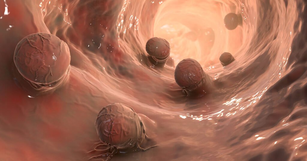 rectal cancer deaths young adults