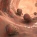 rectal cancer deaths young adults